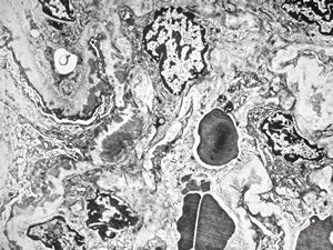 F,40y. | membranous glomerulopathy - lupus erythematodes F,40y. | membranous glomerulopathy - lupus erythematodes